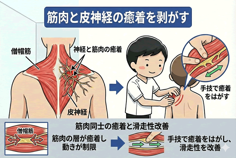 筋肉と神経の癒着を剥がす