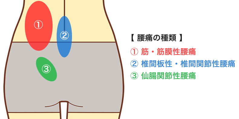 痛む場所による腰痛の原因の違い