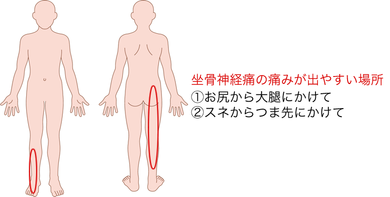 坐骨神経痛